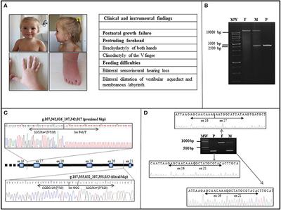 Segmental Maternal UPD of Chromosome 7q in a Patient With Pendred and Silver Russell Syndromes-Like Features